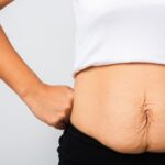 Loose Skin After Gastric Bypass