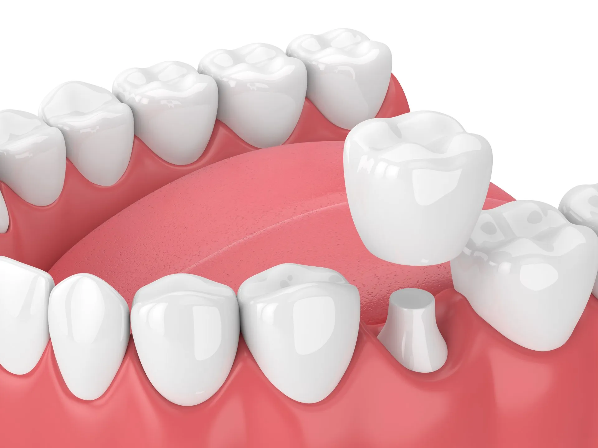 Porcelain crowns: Luxurious Dental Solutions 